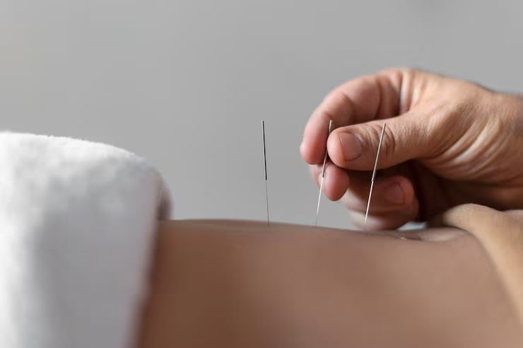 Acupuntura de medicina tradicional china